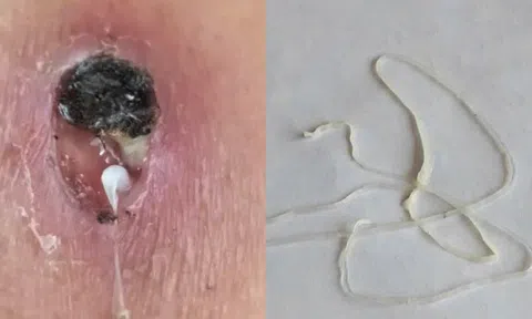 Phát hiện ca bệnh giun rồng hiếm gặp tại Phú Thọ